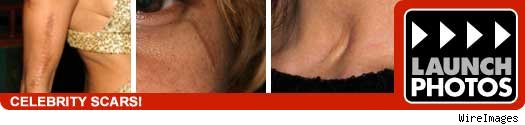 celebrity scars
