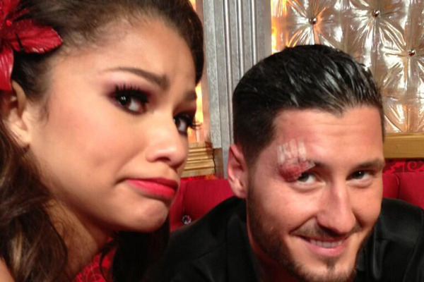 Zendaya Injures Val Chmerkovskiy -- See His Gross Eye Injury!