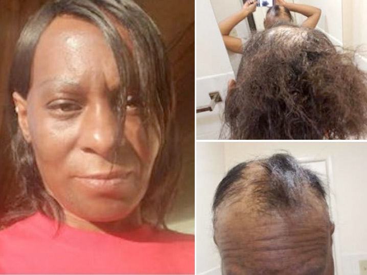 L'Oréal Sued -- No-Lye ... You Burned My Head!!! (PHOTO GALLERY)